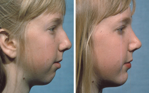 Chin Implants Before and After Patient 11