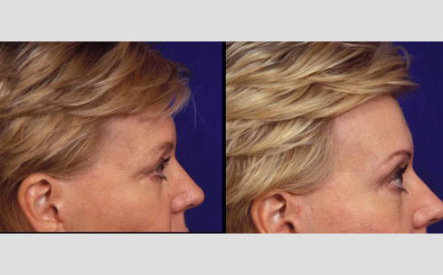 Eyebrow and Forehead Lift Before and After Patient 3