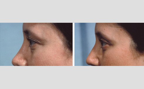 Eyelid Surgery Before and After Patient 21