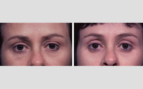 Eyelid Surgery Before and After Patient 22