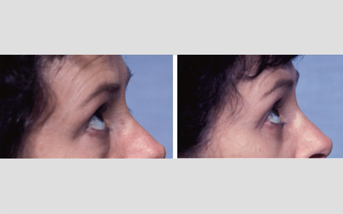 Eyelid Surgery Before and After Patient 23
