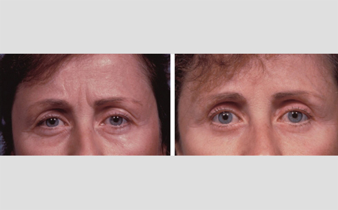 Eyelid Surgery Before and After Patient 24