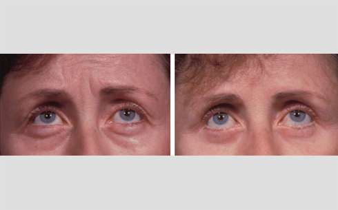 Eyelid Surgery Before and After Patient 25