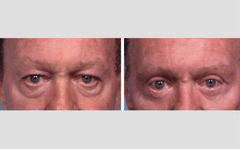 Eyelid Surgery Before and After Patient 26