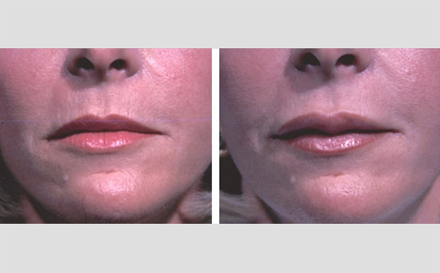 Facial Fillers and Lip Enhancement Before and After Patient 1