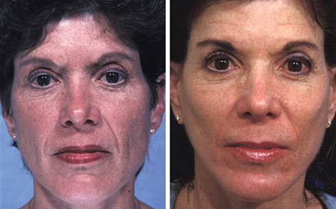 Facelift and Midface Implants Before and After Patient 11