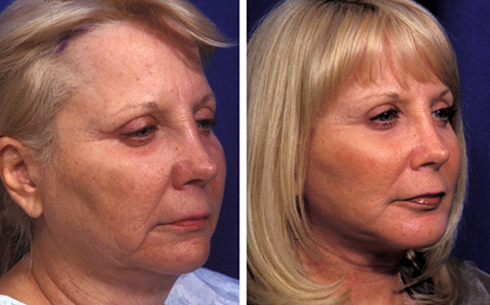 Facelift and Midface Implants Before and After Patient 12