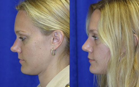 Revision Rhinoplasty Before and After Patient 11