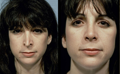 Revision Rhinoplasty Before and After Patient 12