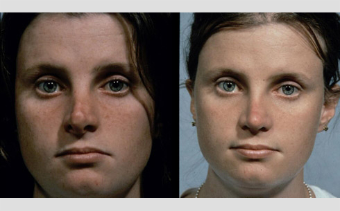 Revision Rhinoplasty Before and After Patient 14