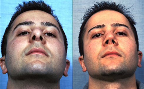 Revision Rhinoplasty Before and After Patient 15