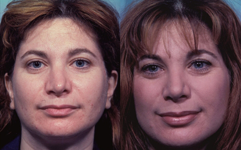 Revision Rhinoplasty Before and After Patient 16