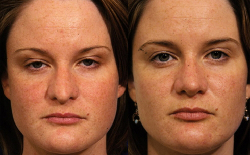 Revision Rhinoplasty Before and After Patient 1