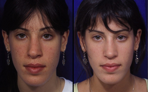 Revision Rhinoplasty Before and After Patient 18