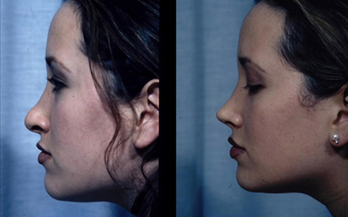 Revision Rhinoplasty Before and After Patient 19