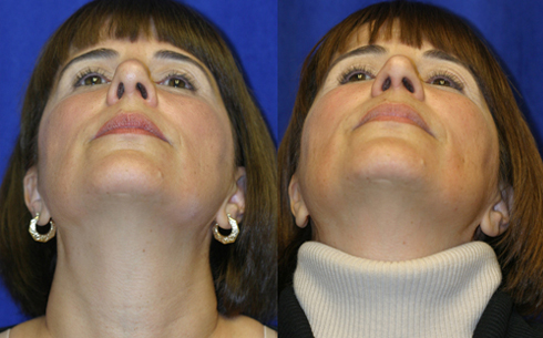 Revision Rhinoplasty Before and After Patient 20