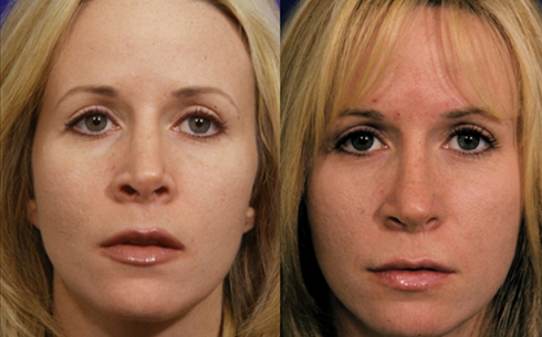 Revision Rhinoplasty Before and After Patient 2