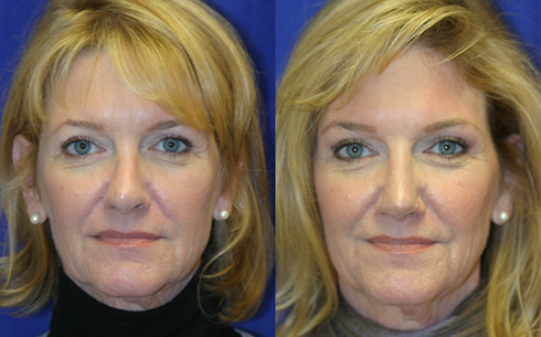 Revision Rhinoplasty Before and After Patient 21