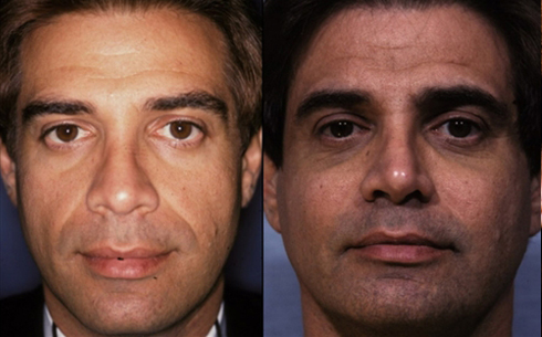 Revision Rhinoplasty Before and After Patient 5