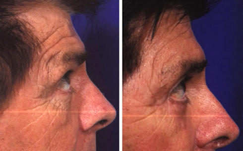 Midface Lift Before and After Patient 3