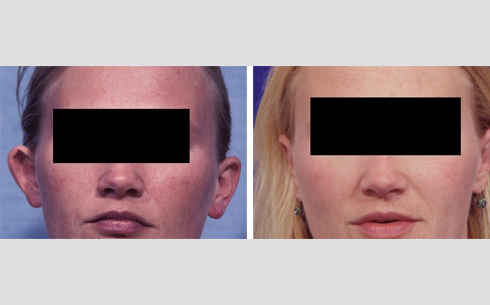 Otoplasty Before and After Patient 1