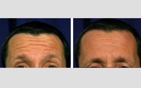 Botox Before and After Patient 11