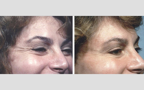 Botox Before and After Patient 12