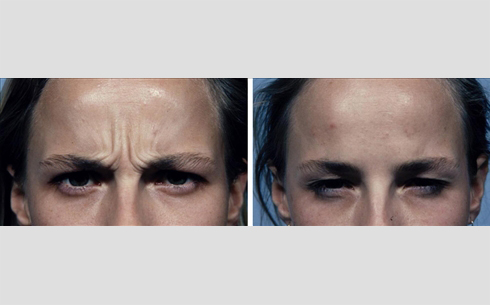 Botox Before and After Patient 3
