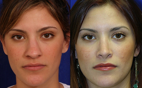 Rhinoplasty Before and After Patient 21