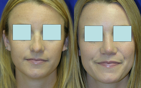 Rhinoplasty Before and After Patient 25