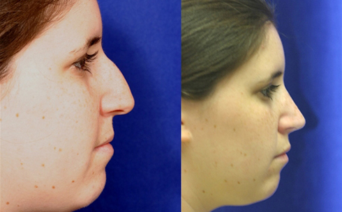 Rhinoplasty Before and After Patient 26