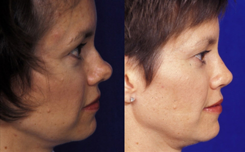 Rhinoplasty Before and After Patient 27