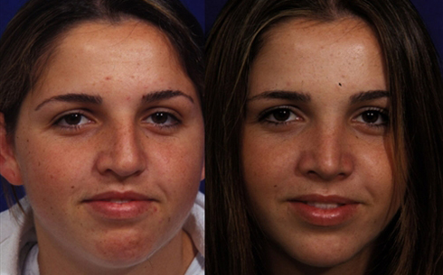 Rhinoplasty Before and After Patient 29