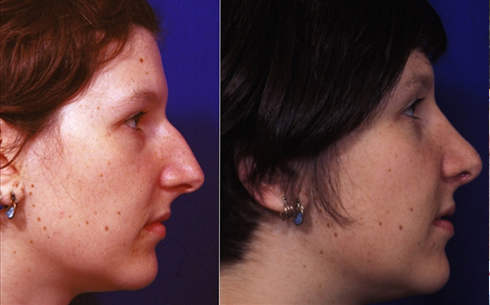 Rhinoplasty Before and After Patient 33