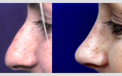 Rhinoplasty Before and After Patient 34