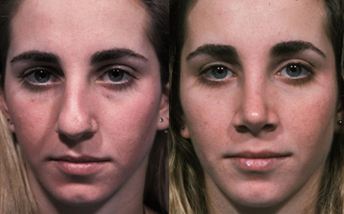 Rhinoplasty Before and After Patient 43