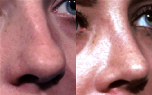 Rhinoplasty Before and After Patient 37