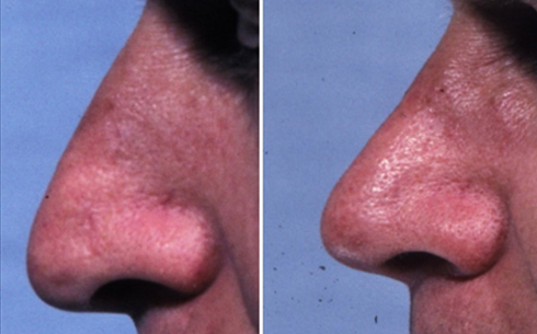 Rhinoplasty Before and After Patient 44