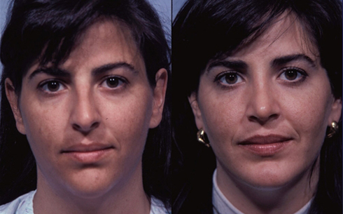Rhinoplasty Before and After Patient 21