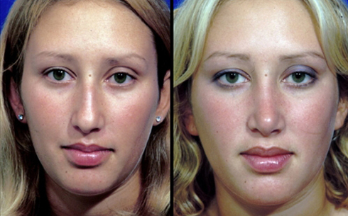 Rhinoplasty Before and After Patient 31