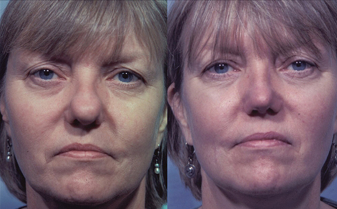 Rhinoplasty Before and After Patient 40