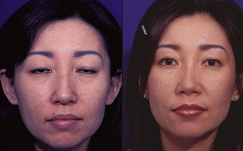 Rhinoplasty Before and After Patient 39