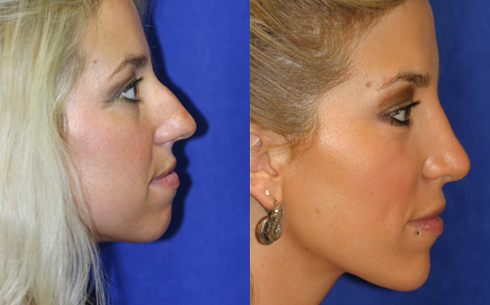 rhinoplasty-success-3