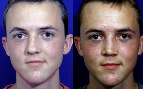 Rhinoplasty Before and After Patient 30