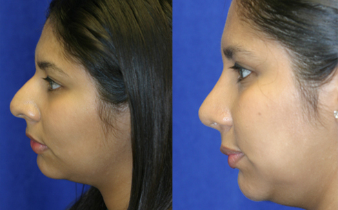 Rhinoplasty Before and After Patient 42