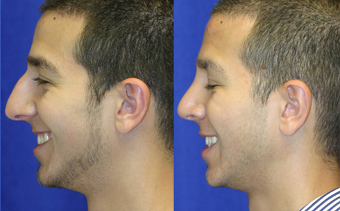 Rhinoplasty Before and After Patient 6