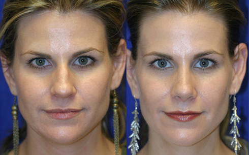 Rhinoplasty Before and After Patient 13