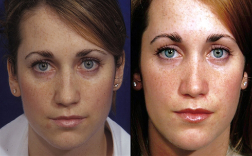 Rhinoplasty Before and After Patient 35