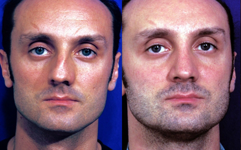 rhinoplasty-success-story