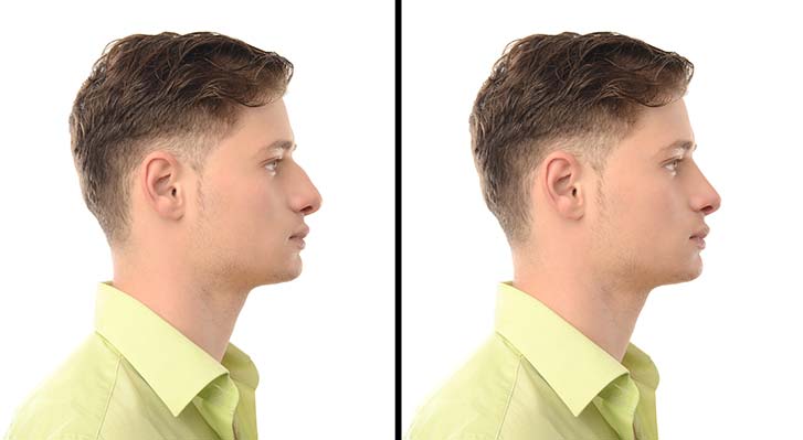 rhinoplasty-reasons